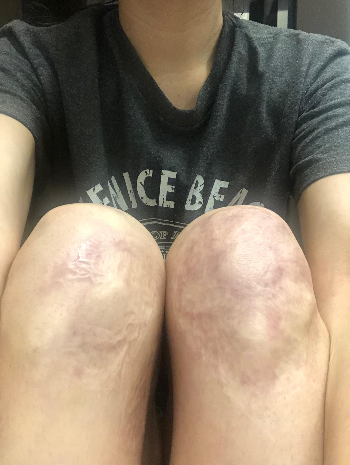Blog about knee skingraft