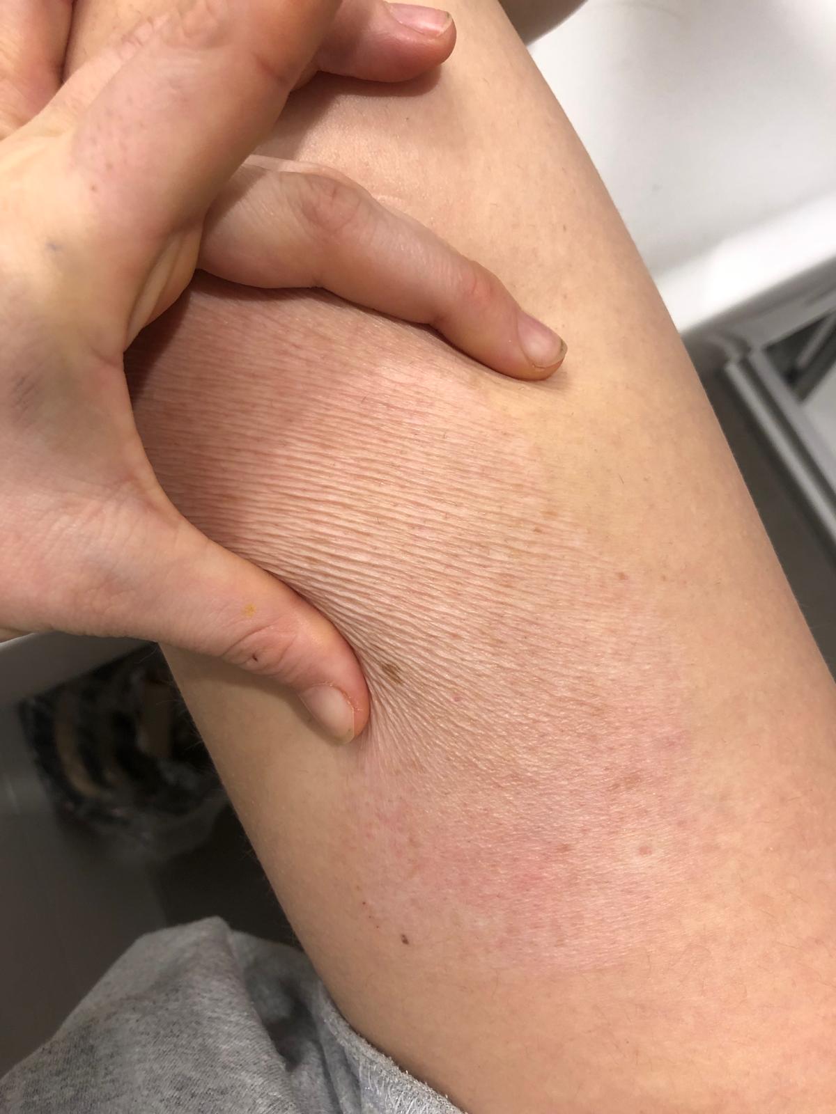 Blog about knee skingraft