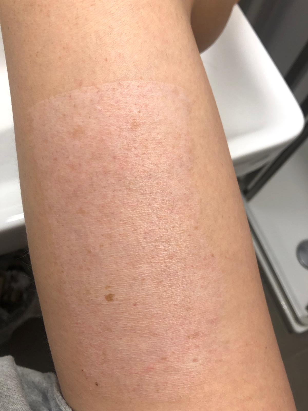 Blog about knee skingraft