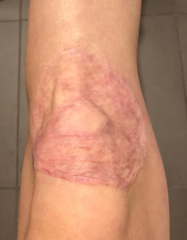 Blog about knee skingraft