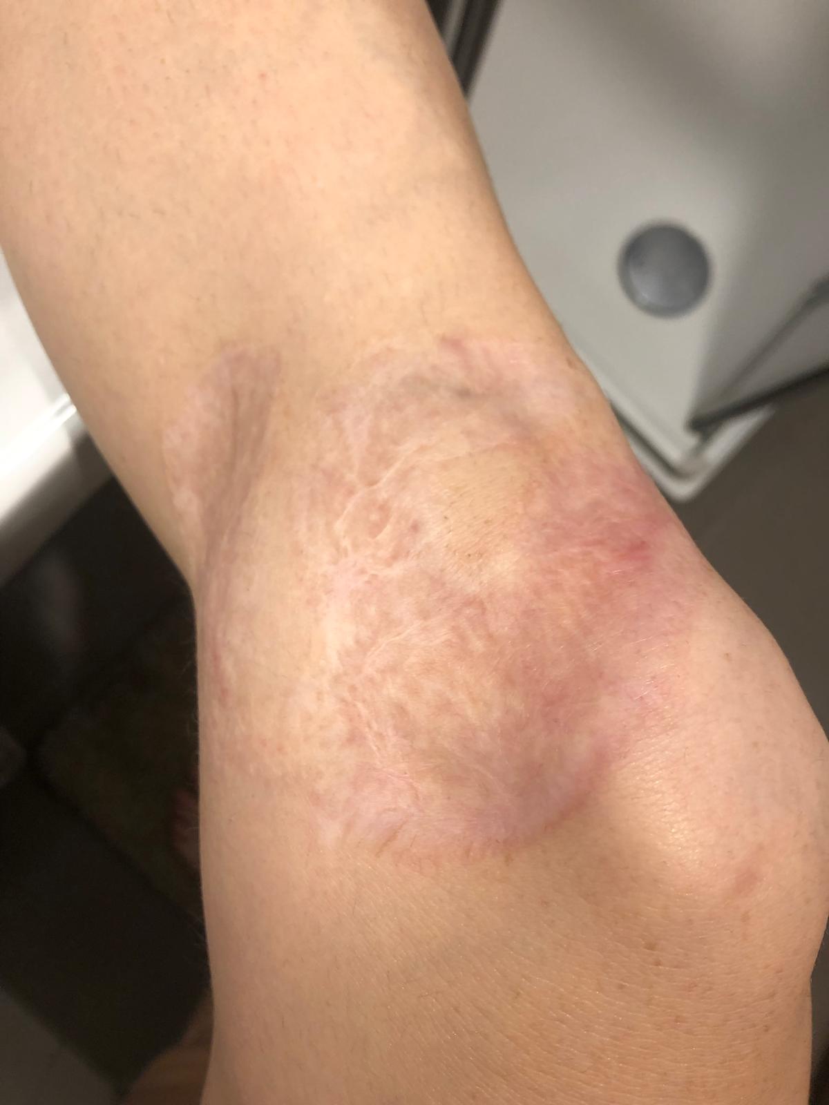 Blog about knee skingraft