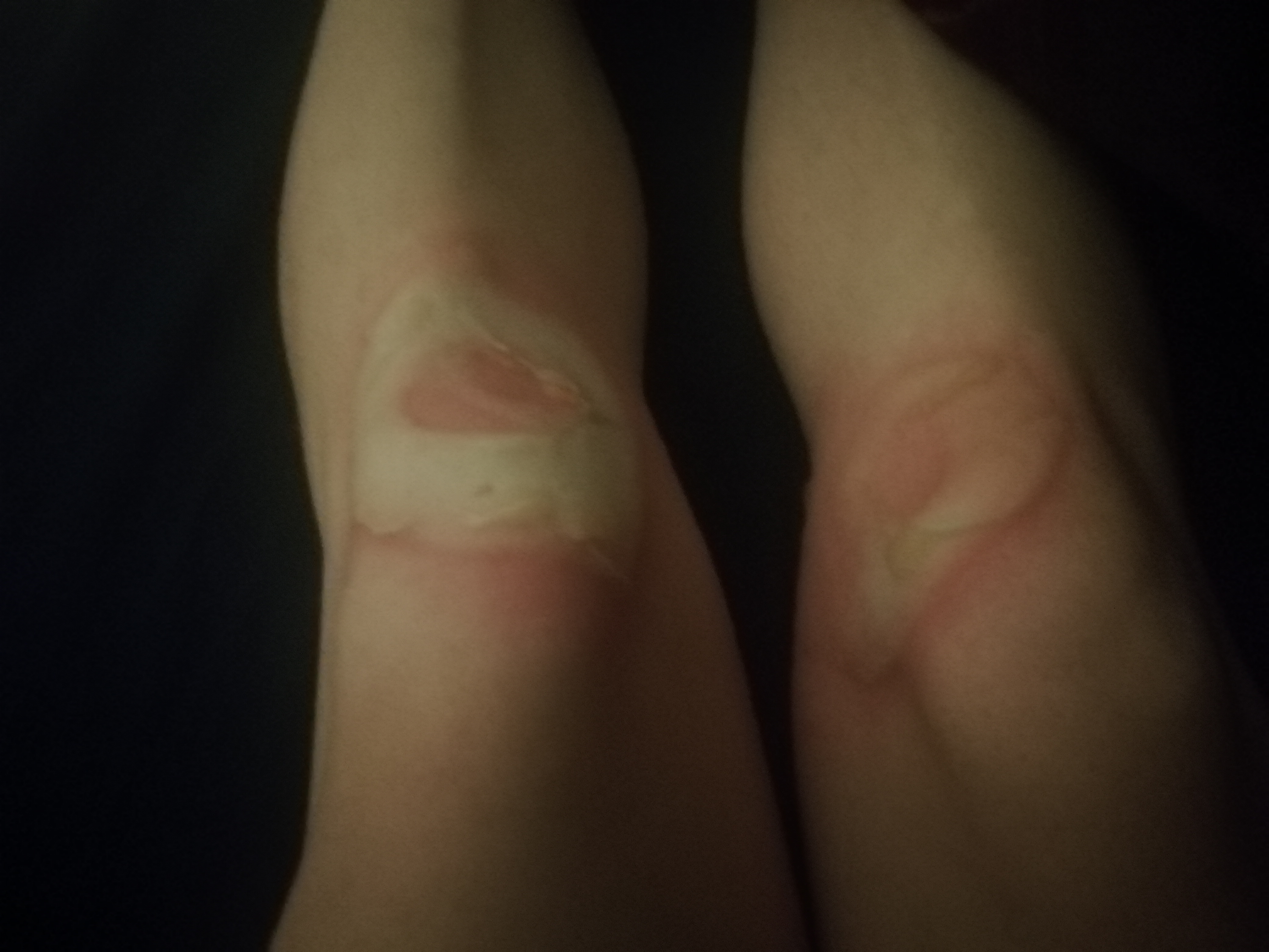 The day I got burned