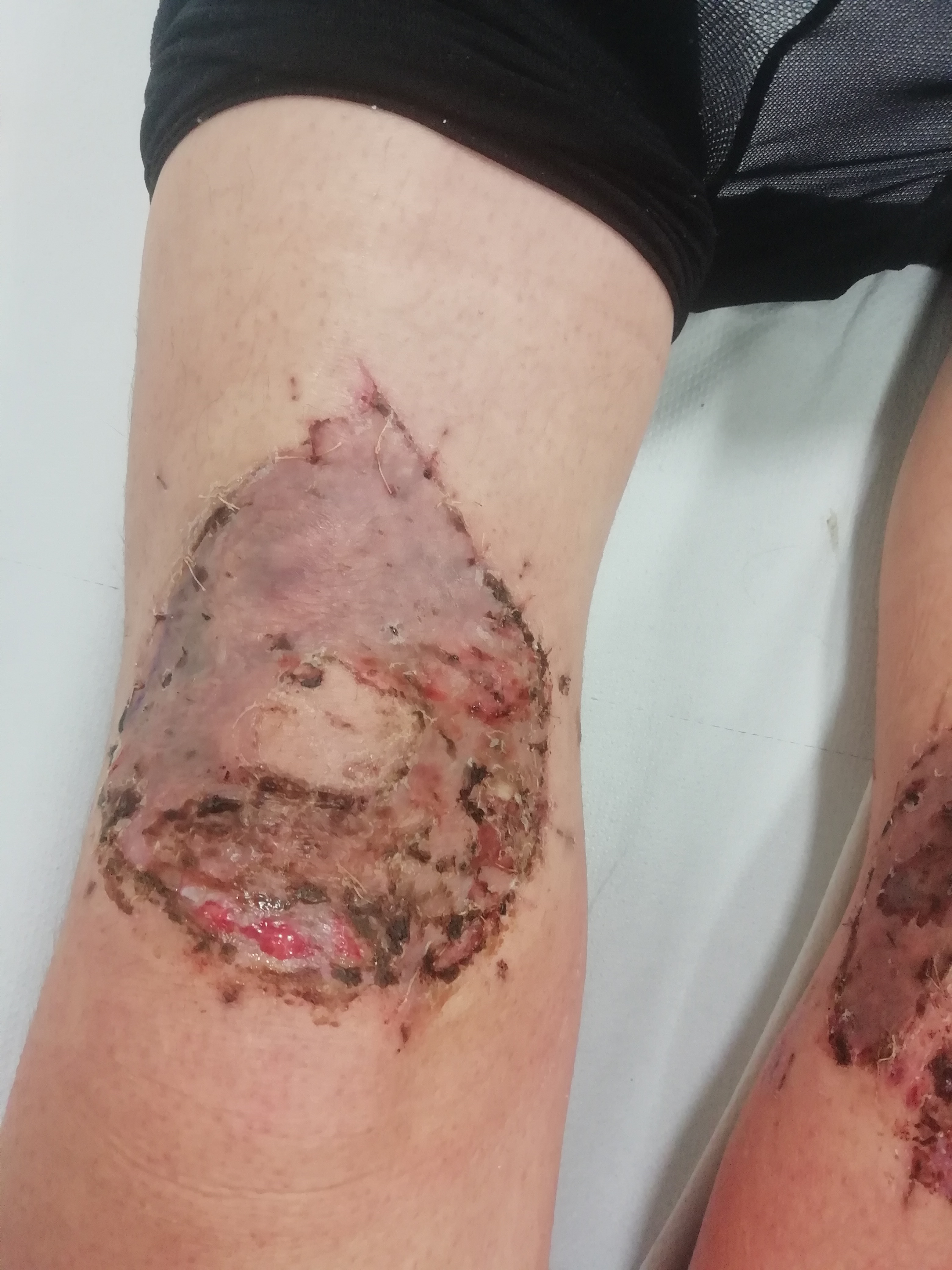 Blog about knee skingraft
